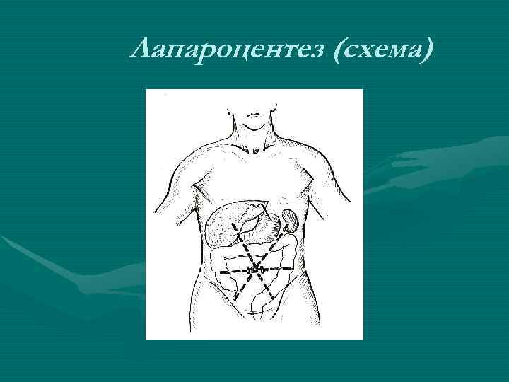 Лапароцентез (схема) Лапароцентез (схема)