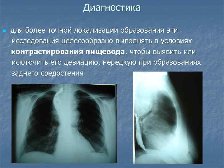      Диагностика n  для более точной локализации образования эти
