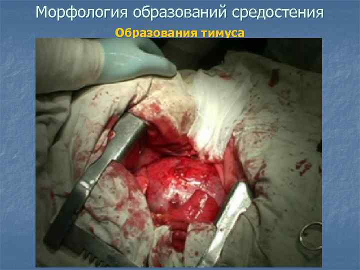 Морфология образований средостения   Образования тимуса 