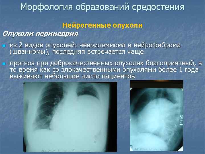   Морфология образований средостения    Нейрогенные опухоли Опухоли периневрия n 