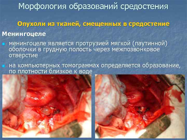  Морфология образований средостения  Опухоли из тканей, смещенных в средостение Менингоцеле n менингоцеле