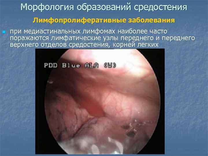  Морфология образований средостения  Лимфопролиферативные заболевания n  при медиастинальных лимфомах наиболее часто