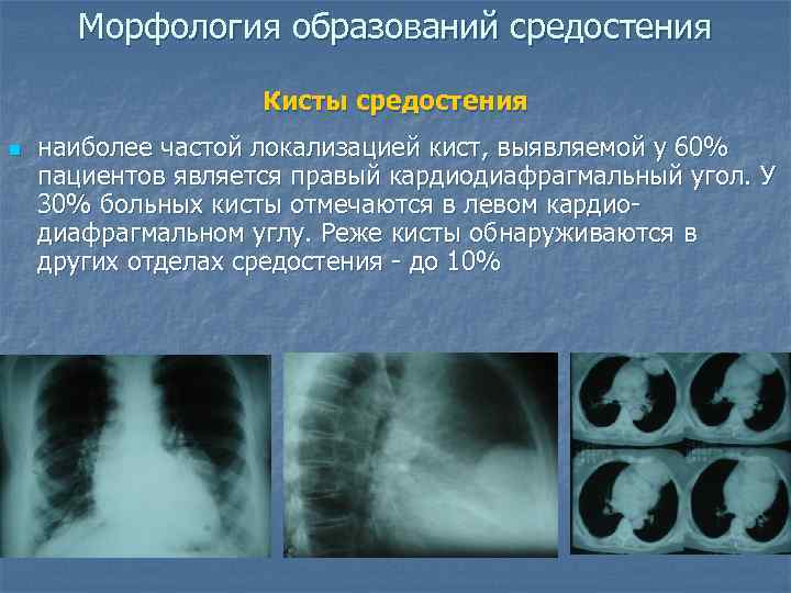 Опухоли средостения презентация