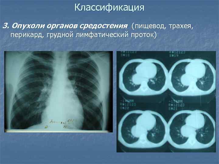 Опухоль средостения. Опухоли средостения презентация. Опухоли средостения перикарда. Опухоли средостения у детей эпидемиология. Мягкотканные опухоли классификация средостения.