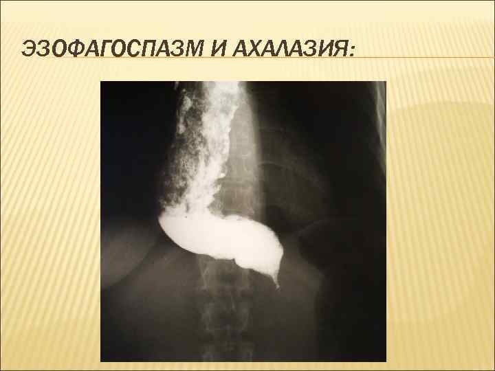 ЭЗОФАГОСПАЗМ И АХАЛАЗИЯ: 