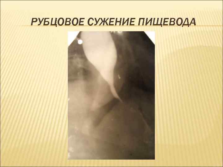 РУБЦОВОЕ СУЖЕНИЕ ПИЩЕВОДА 