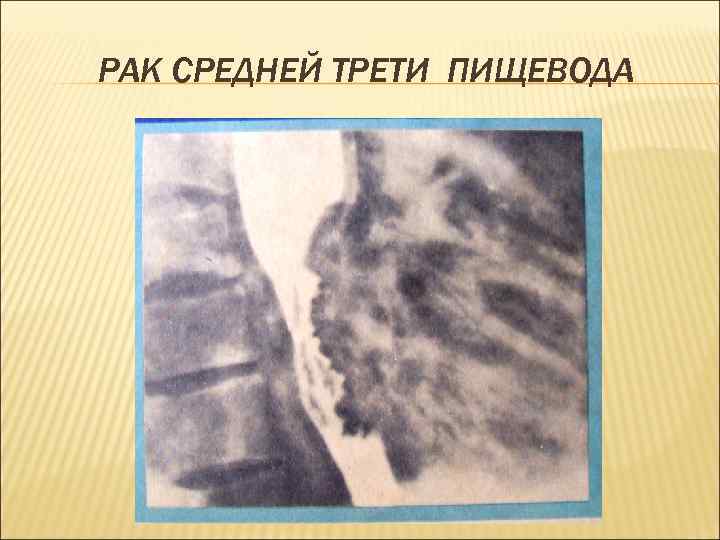 РАК СРЕДНЕЙ ТРЕТИ ПИЩЕВОДА 