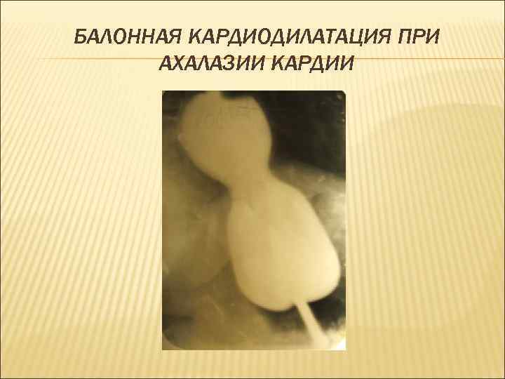 БАЛОННАЯ КАРДИОДИЛАТАЦИЯ ПРИ  АХАЛАЗИИ КАРДИИ 
