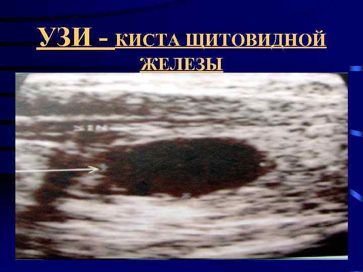 УЗИ - КИСТА ЩИТОВИДНОЙ  ЖЕЛЕЗЫ 