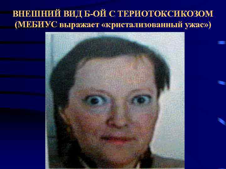 ВНЕШНИЙ ВИД Б-ОЙ С ТЕРИОТОКСИКОЗОМ (МЕБИУС выражает «кристализованный ужас» ) 
