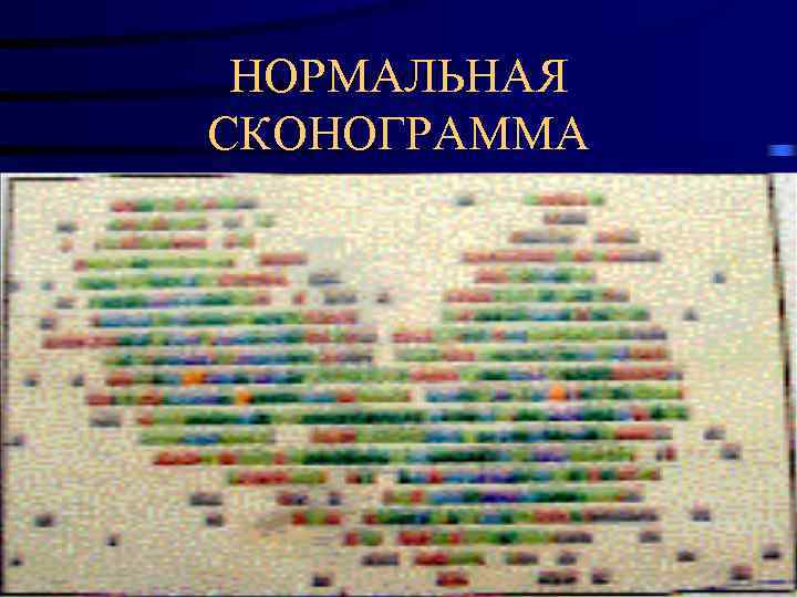  НОРМАЛЬНАЯ СКОНОГРАММА 
