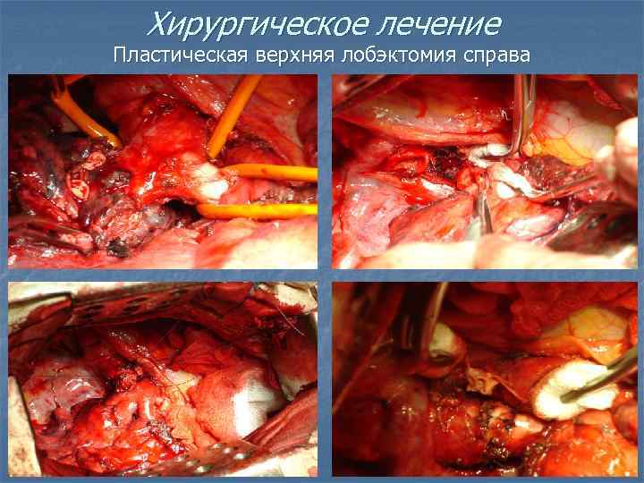   Хирургическое лечение Пластическая верхняя лобэктомия справа 
