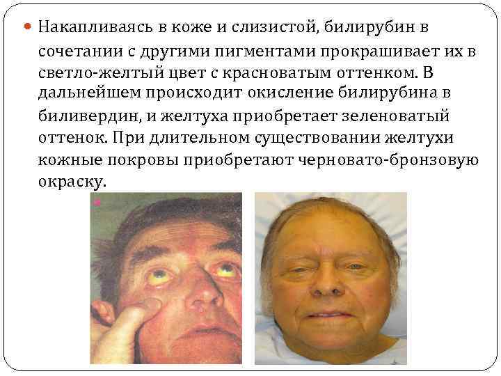  Накапливаясь в коже и слизистой, билирубин в сочетании с другими пигментами прокрашивает их