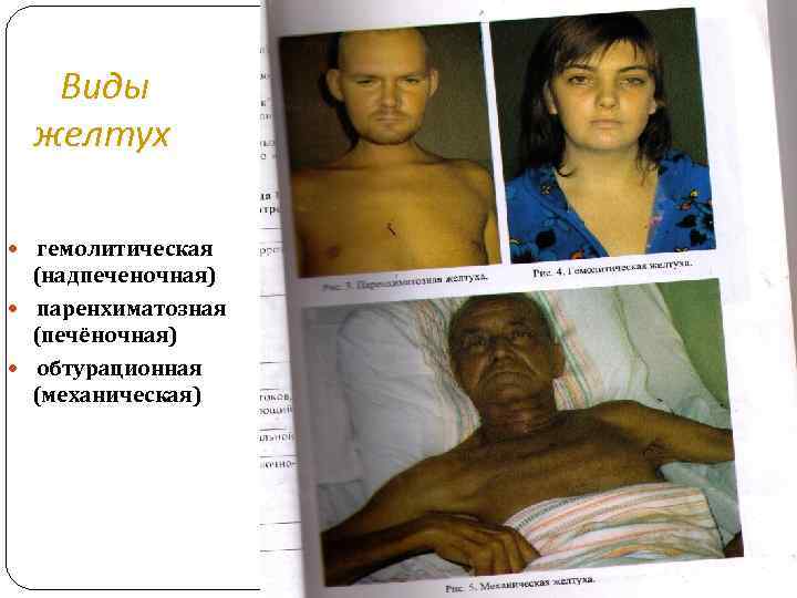   Виды желтух  гемолитическая  (надпеченочная)  паренхиматозная  (печёночная)  обтурационная