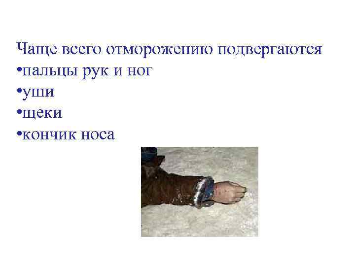Чаще всего отморожению подвергаются • пальцы рук и ног • уши • щеки •