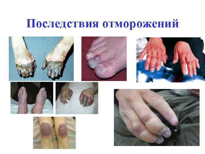 Последствия отморожений 