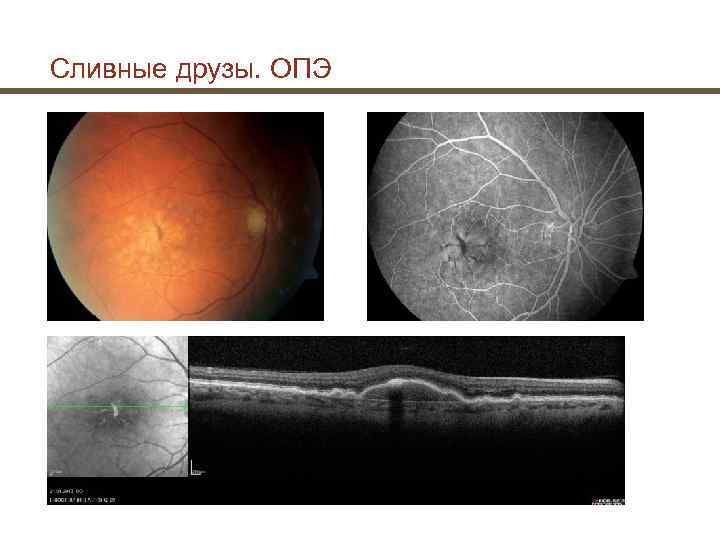 Сливные друзы. ОПЭ 