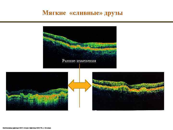     Мягкие «сливные» друзы      Ранние изменения
