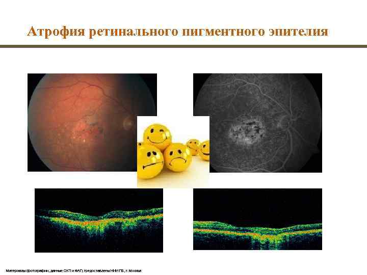 Поздняя смена. Ретинальный пигментный эпителий. Гипертрофия и гиперплазия ретинального пигментного эпителия. Нефро ретинальный синдром. Периферические ретинальные дегенерации н35.4.