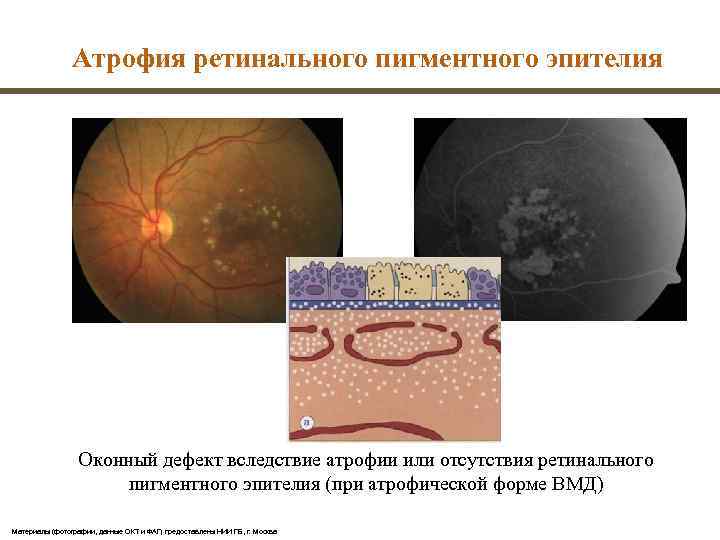     Атрофия ретинального пигментного эпителия    Оконный дефект вследствие
