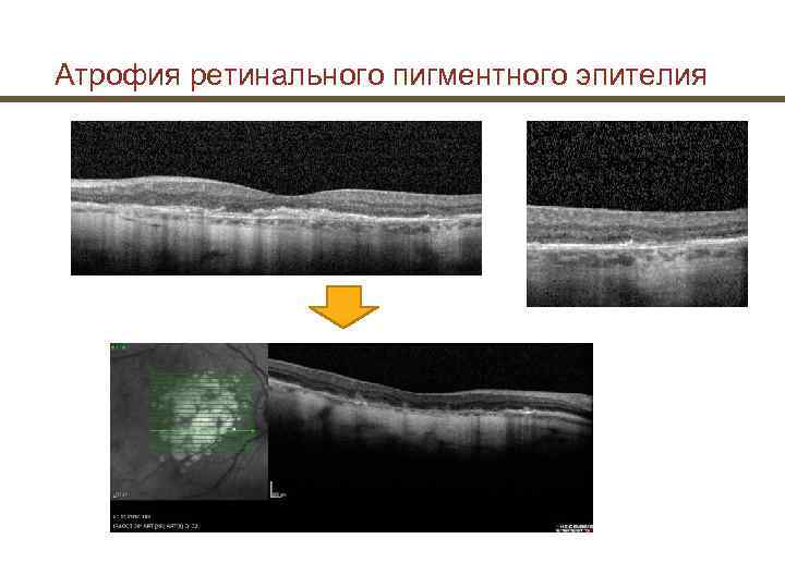 Атрофия ретинального пигментного эпителия 