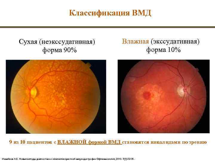      Классификация ВМД    Сухая (неэкссудативная)  