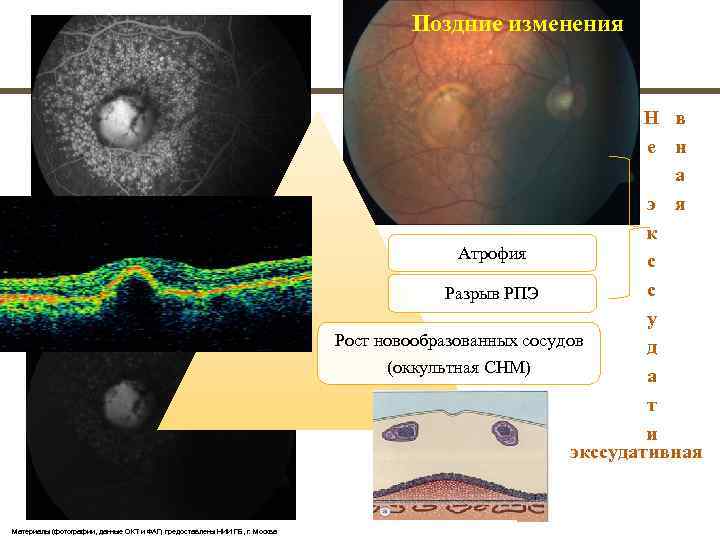       Поздние  изменения    