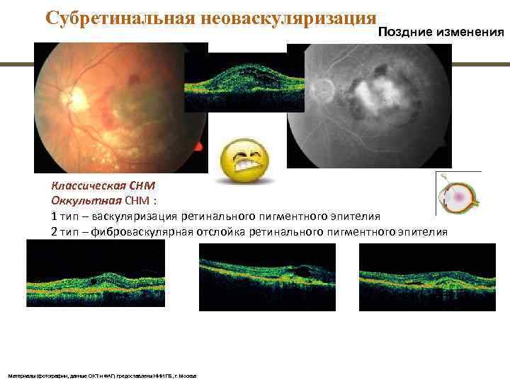    Субретинальная неоваскуляризация       Поздние изменения 