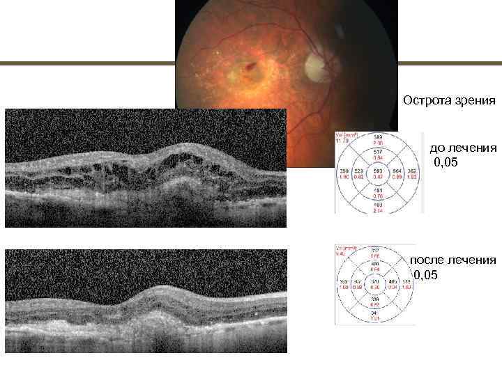 Острота зрения  до лечения 0, 05 после лечения  0, 05 