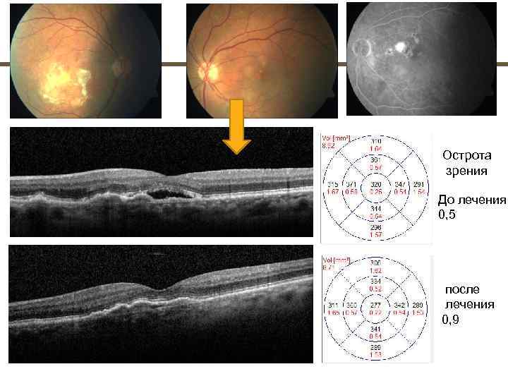 Острота зрения До лечения 0, 5 после лечения 0, 9 
