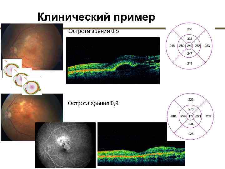 Острота зрения больше при фокусировке изображения