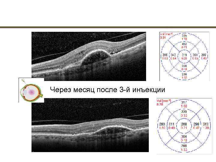 Через месяц после 3 й инъекции 