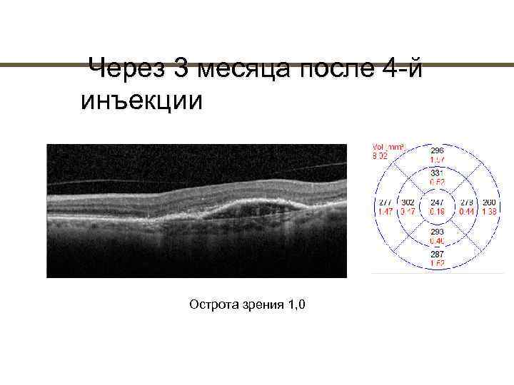  Через 3 месяца после 4 й инъекции   Острота зрения 1, 0