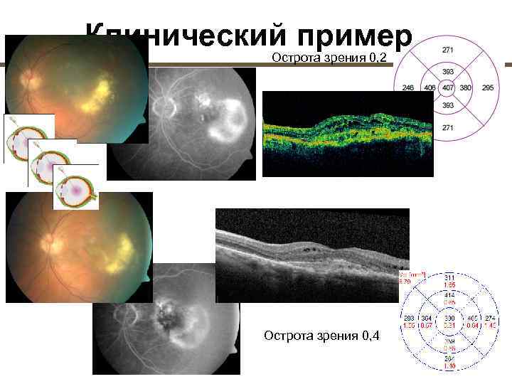 Острота зрения больше при фокусировке изображения