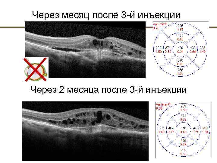 Через месяц после 3 й инъекции Через 2 месяца после 3 й инъекции 