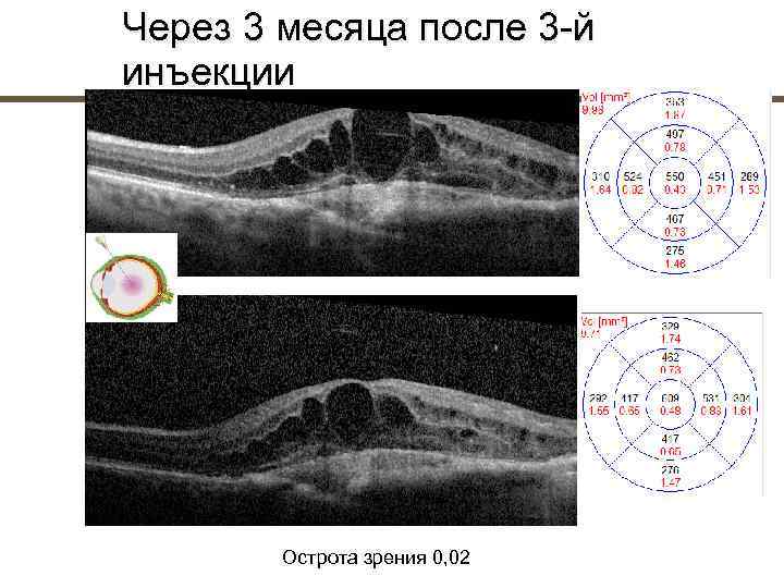 Через 3 месяца после 3 й инъекции   Острота зрения 0, 02 