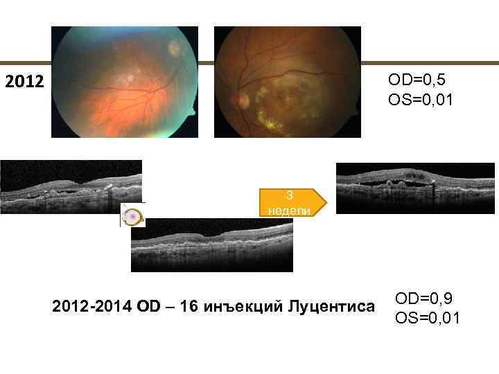 2012       OD=0, 5    OS=0, 01