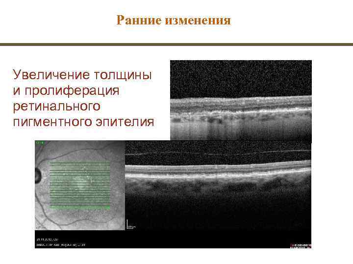    Ранние изменения  Увеличение толщины и пролиферация ретинального пигментного эпителия 