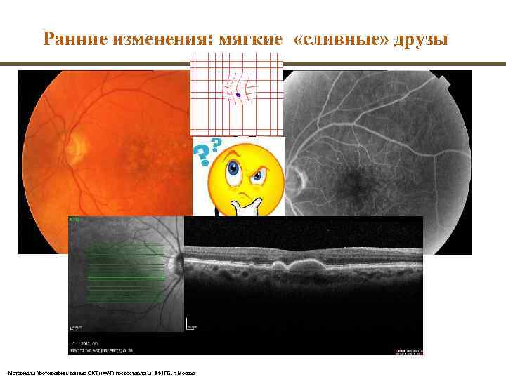    Ранние изменения: мягкие «сливные» друзы Материалы (фотографии, данные ОКТ и ФАГ)