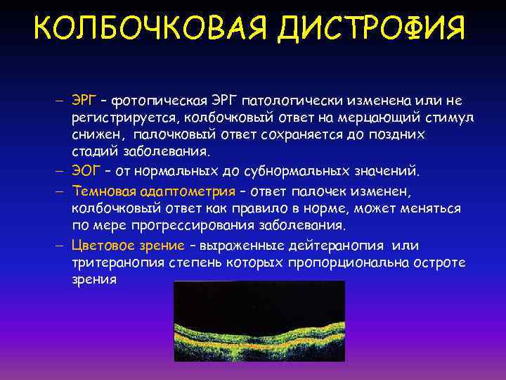 КОЛБОЧКОВАЯ ДИСТРОФИЯ.  – ЭРГ – фотопическая ЭРГ патологически изменена или не  регистрируется,