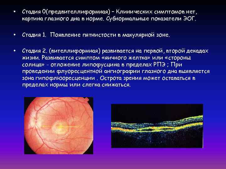 Пигментный ретинит презентация