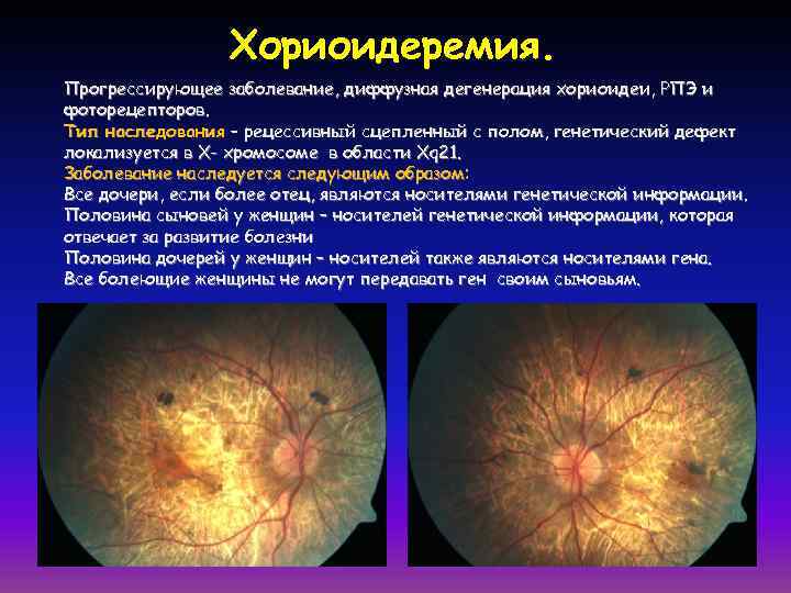    Хориоидеремия. Прогрессирующее заболевание, диффузная дегенерация хориоидеи, РПЭ и фоторецепторов. Тип наследования
