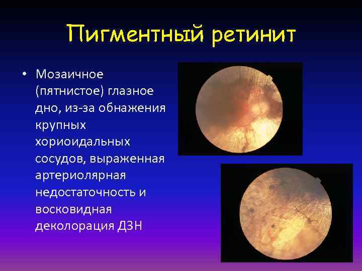  Пигментный ретинит • Мозаичное  (пятнистое) глазное  дно, из-за обнажения  крупных