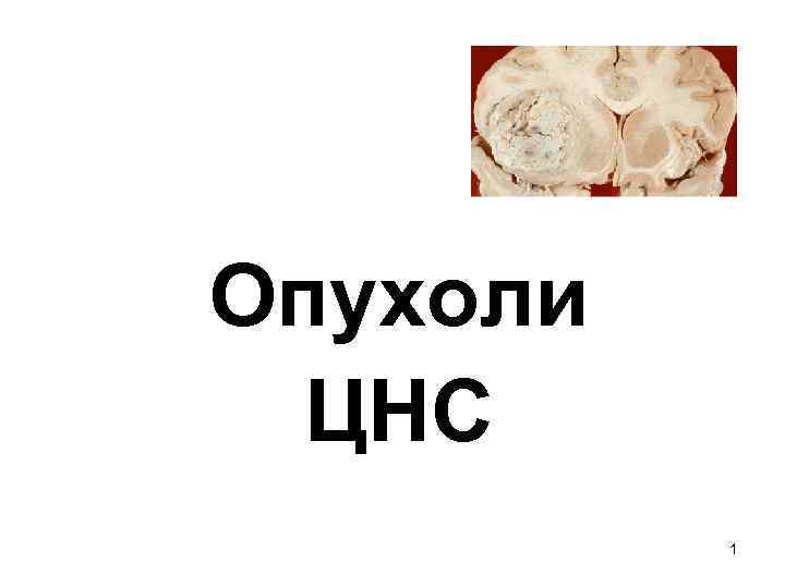 Опухоли  ЦНС  1 