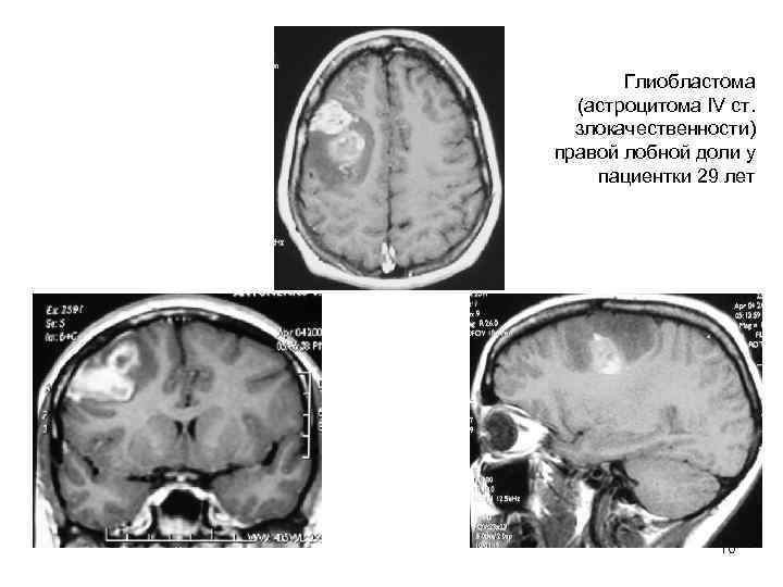   Глиобластома  (астроцитома IV ст. злокачественности) правой лобной доли у пациентки 29