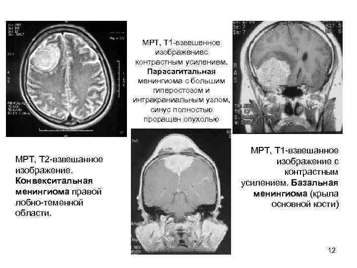      МРТ, Т 1 взвешенное     