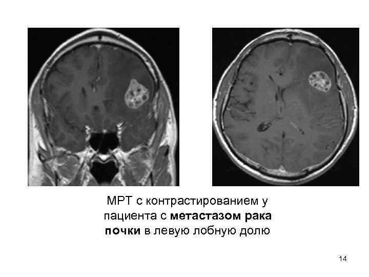  МРТ с контрастированием у пациента с метастазом рака почки в левую лобную долю