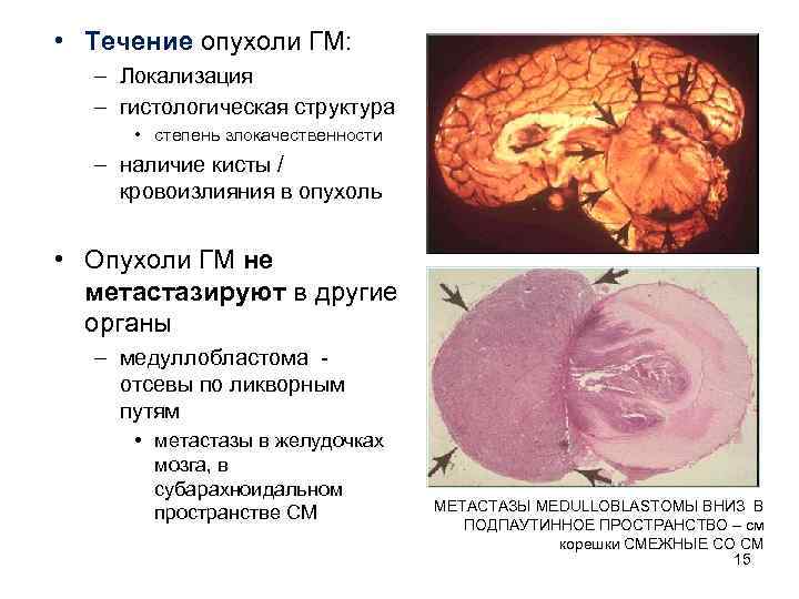  • Течение опухоли ГМ: – Локализация  – гистологическая структура  • степень
