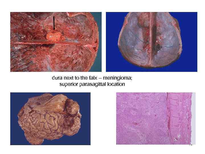 dura next to the falx – meningioma; superior parasagittal location    19