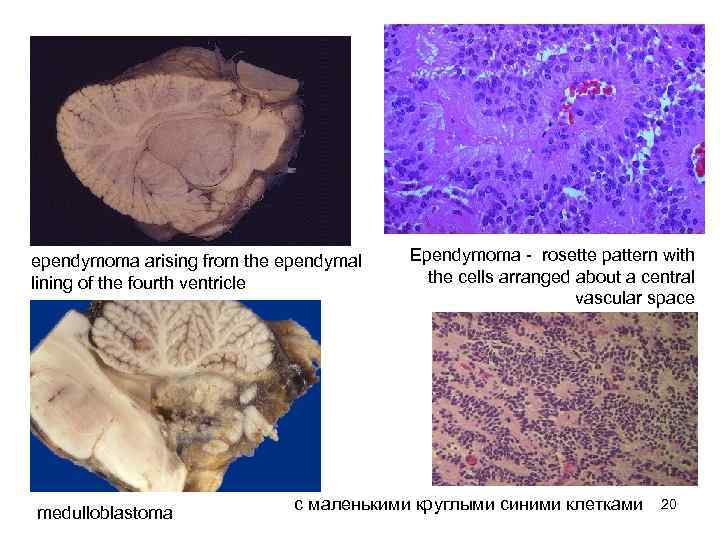 ependymoma arising from the ependymal  Ependymoma  rosette pattern with lining of the